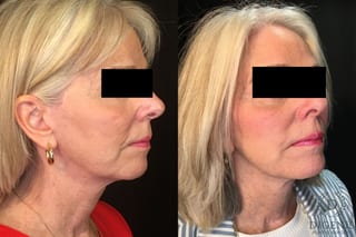 Before and after Temple Lift case 35194 - Angle 2