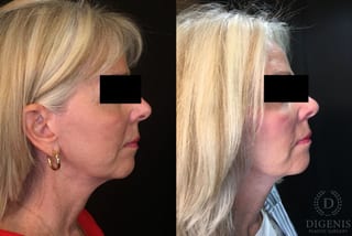 Before and after Temple Lift case 35194 - Angle 3