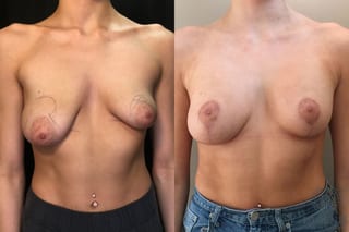 Before and after Breast Lift with or without Implants case 35195 - Angle 1