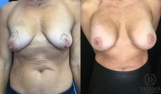 Before and after Breast Lift with or without Implants case 35196 - Angle 1