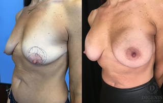 Before and after Breast Lift with or without Implants case 35196 - Angle 4