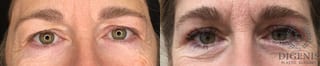 Before and after Eye Lid Surgery case 35204 - Angle 1