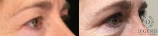Before and after Eye Lid Surgery case 35204 - Angle 2