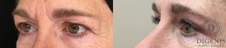 Before and after Eye Lid Surgery case 35204 - Angle 4