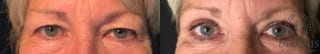 Before and after Eye Lid Surgery case 35208 - Angle 1