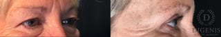 Before and after Eye Lid Surgery case 35208 - Angle 2