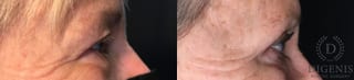 Before and after Eye Lid Surgery case 35208 - Angle 3