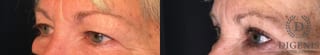 Before and after Eye Lid Surgery case 35208 - Angle 4