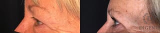 Before and after Eye Lid Surgery case 35208 - Angle 5