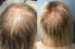 Before and after Hair Restoration/ Hair Thinning case 35257 - Angle 1