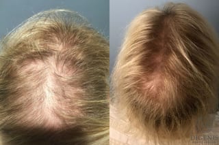 Before and after Hair Restoration/ Hair Thinning case 35257 - Angle 2