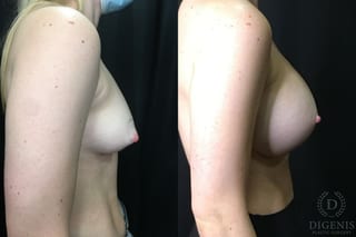 Before and after Breast Augmentation case 35177 - Angle 3