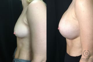 Before and after Breast Augmentation case 35177 - Angle 5