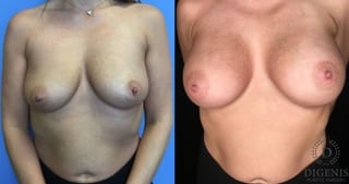 Before and after Breast Augmentation case 35176 - Angle 1