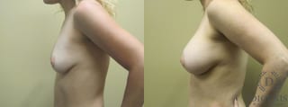 Before and after Breast Augmentation case 35106 - Angle 5