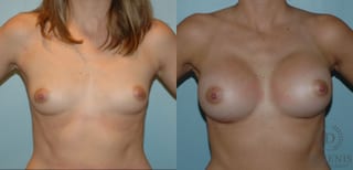 Before and after Breast Augmentation case 35084 - Angle 1