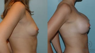 Before and after Breast Augmentation case 35084 - Angle 2