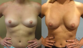 Before and after Breast Augmentation case 35091 - Angle 1