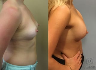 Before and after Breast Augmentation case 35091 - Angle 3