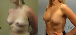 Before and after Breast Augmentation case 35091 - Angle 4