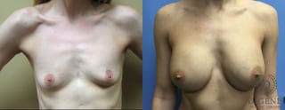 Before and after Breast Augmentation case 35041 - Angle 1