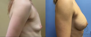Before and after Breast Augmentation case 35041 - Angle 3