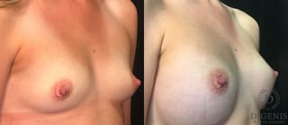 Before and after Breast Augmentation case 35050 - Angle 2