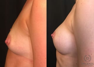 Before and after Breast Augmentation case 35050 - Angle 5