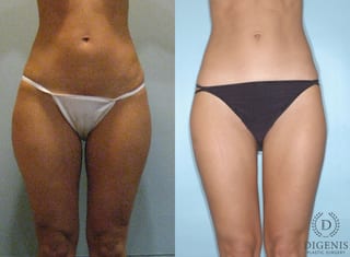Before and after Liposuction case 35103 - Angle 1