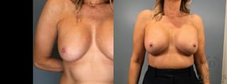 Before and after Breast Implant Exchange or Removal case 41360 - Angle 1