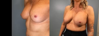 Before and after Breast Implant Exchange or Removal case 41360 - Angle 2