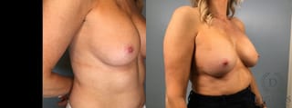 Before and after Breast Implant Exchange or Removal case 41360 - Angle 4