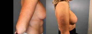 Before and after Breast Implant Exchange or Removal case 41360 - Angle 5