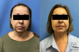 Before and after Face Lift/Neck Lift case 34970 - Angle 1