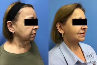 Before and after Face Lift/Neck Lift case 34970 - Angle 2