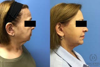 Before and after Face Lift/Neck Lift case 34970 - Angle 3