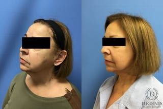 Before and after Face Lift/Neck Lift case 34970 - Angle 4