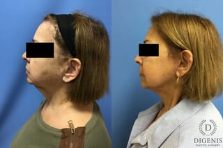 Before and after Face Lift/Neck Lift case 34970 - Angle 5
