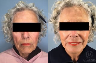 Before and after Face Lift/Neck Lift case 41357 - Angle 1