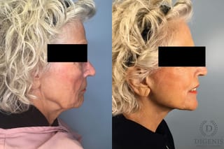 Before and after Face Lift/Neck Lift case 41357 - Angle 4
