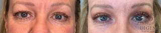 Before and after Eye Lid Surgery case 41341 - Angle 1