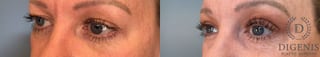 Before and after Eye Lid Surgery case 41341 - Angle 2