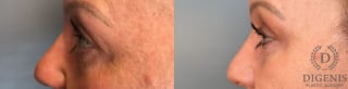 Before and after Eye Lid Surgery case 41341 - Angle 3