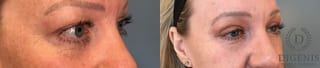 Before and after Eye Lid Surgery case 41341 - Angle 4