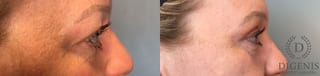 Before and after Eye Lid Surgery case 41341 - Angle 5