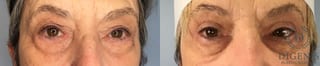 Before and after Eye Lid Surgery case 41677 - Angle 1