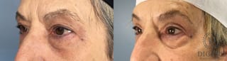 Before and after Eye Lid Surgery case 41677 - Angle 2