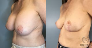 Before and after Breast Lift with or without Implants case 41691 - Angle 2