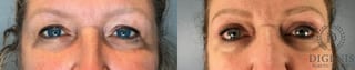 Before and after Eye Lid Surgery case 41693 - Angle 1