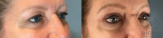 Before and after Eye Lid Surgery case 41693 - Angle 2